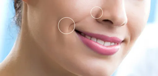 مراقبت‌های قبل و بعد از تزریق فیلر خط خنده